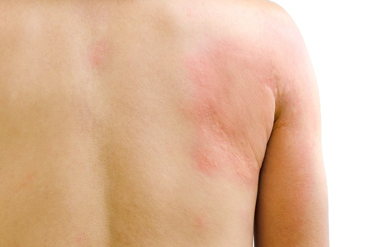 uploads/treatment_packages/1761575911_urticaria.jpg