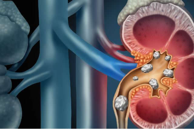 uploads/treatment_packages/1761576720_kidneystonestents.jpg