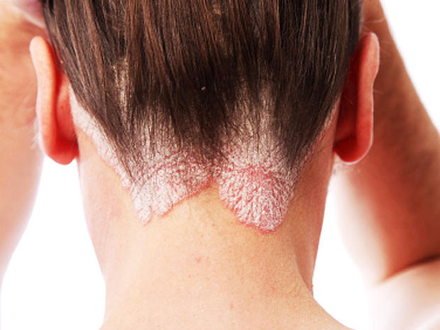 uploads/treatment_packages/1761576854_psoriasis.jpg